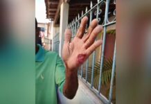 Ipiaú: Mulher arranca pedaço da mão de idoso com mordida após invadir residência da vítima